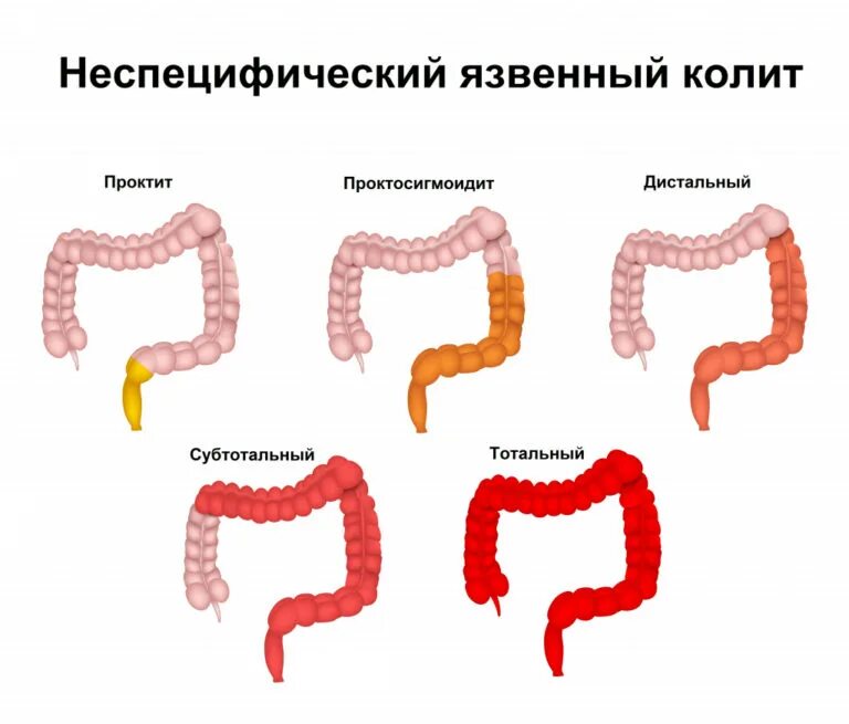 Симптомы хронического колита кишечника у взрослых. Язвенный колит проктит клинические рекомендации. Неспецифический язвенный колит симптомы. Классификация колитов кишечника. Субтотальный язвенный колит.