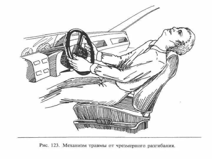 Ушибы при дтп. Механизм травмы внутри автомобиля. травма позвоночника при аварии. фазы автомобильной травмы. механизм травмы при дтп.