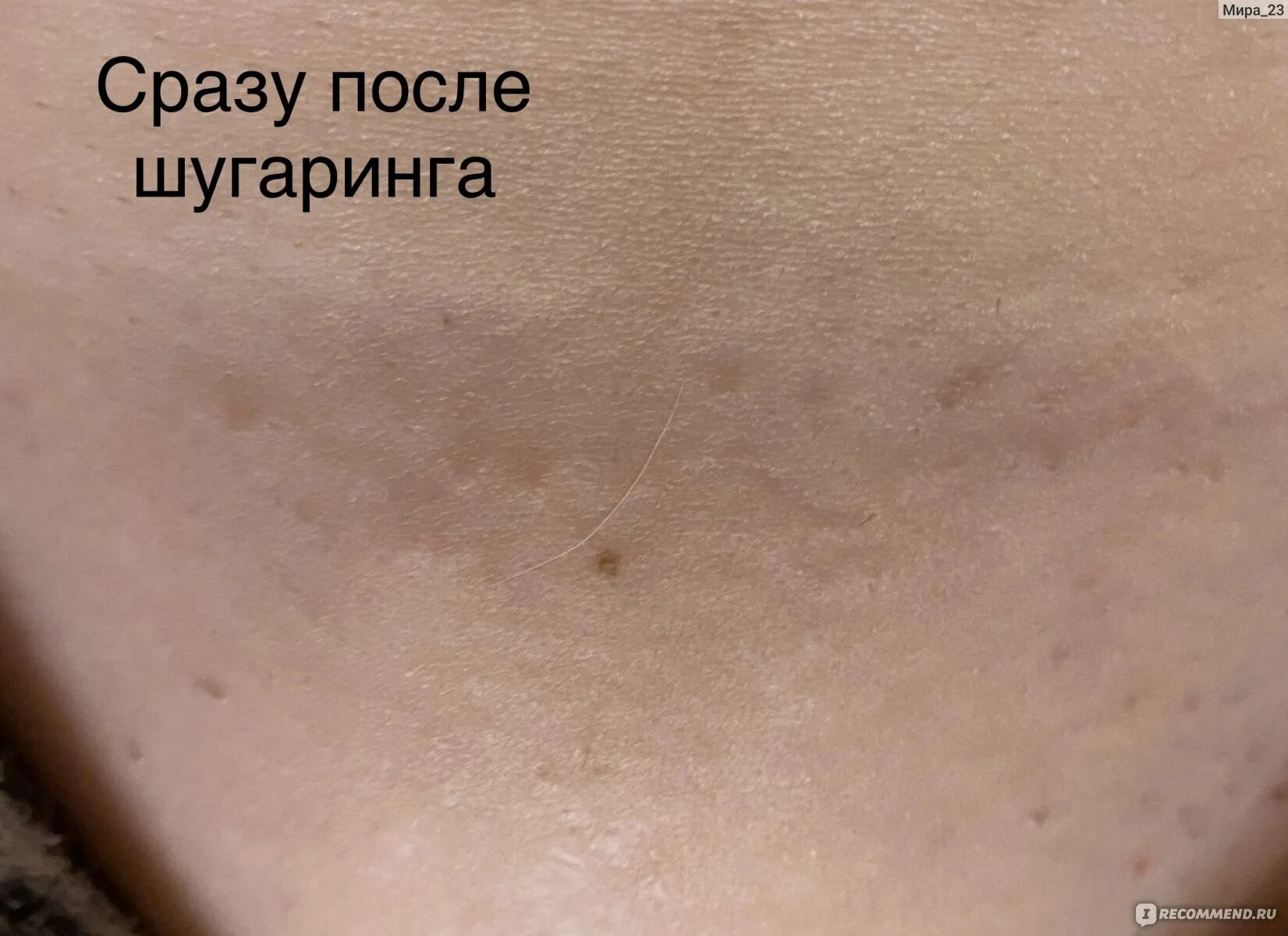 Шугаринг через сколько растут волосы. После шугаринга волосы растут. волосы после шугаринга не растут. отрастание шугаринг волос. обломались волосы после шугаринга.