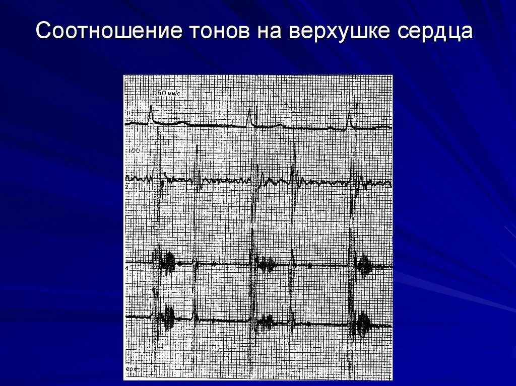 Аритмичные тоны сердца. Фонокардиография методика проведения. Тоны сердца, аускультация, фонокардиография. Фонокардиография презентация. Выслушивание (аускультация) тонов сердца. Фонокардиография..