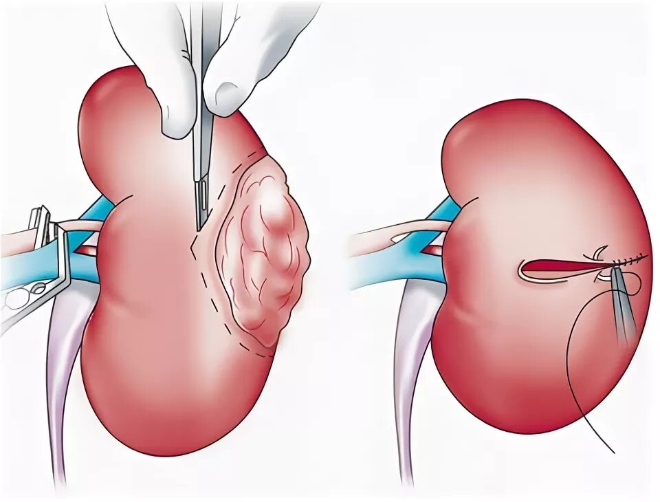 Резекция почки что это. Лапароскопическая нефрэктомия почки. Нефрэктомия почки операция.