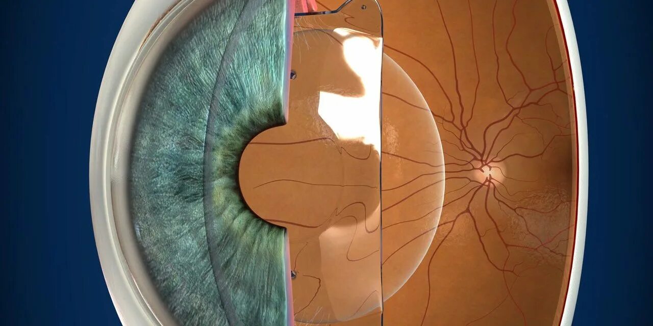 Факоэмульсификация катаракты с имплантацией интраокулярной линзы. Замена хрусталика когда можно в баню. Памятка после операции по замене хрусталика глаза. Операция ультразвуковая факоэмульсификация катаракты. Замена хрусталика когда можно в баню.