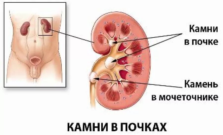 Образования в почке у мужчин. Почечнокаменная болезнь. Мочекаменная болезнь почек. Камни в почках симптоматика.