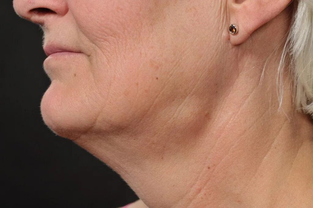 воспаление околоушного лимфатического узла. под скулой. подчелюстные лимфоузлы увеличены. под скулой. припухлость под челюстью.