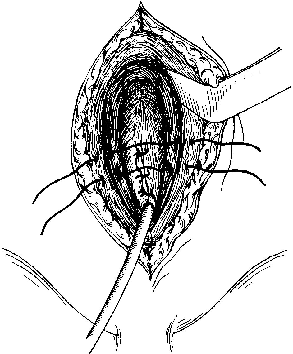 Удаление мочевого пузыря сколько. Операция цистостомия мочевого пузыря. Ушивание РАН мочевого пузыря. Открытая цистостомия техника операции.