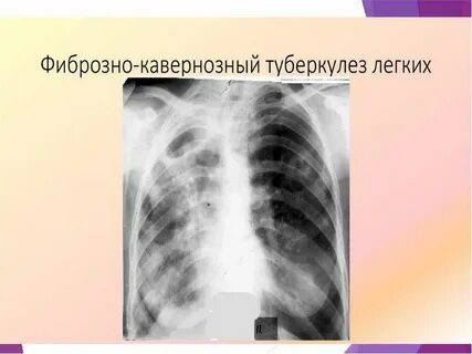 Метатуберкулезное изменение легкого