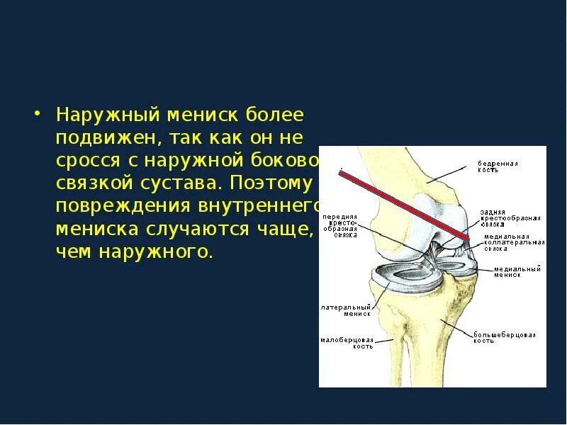 Лечение мениска коленного сустава. Повреждение связок наружного мениска. Наружный мениск коленного сустава. Наружный латеральный мениск.
