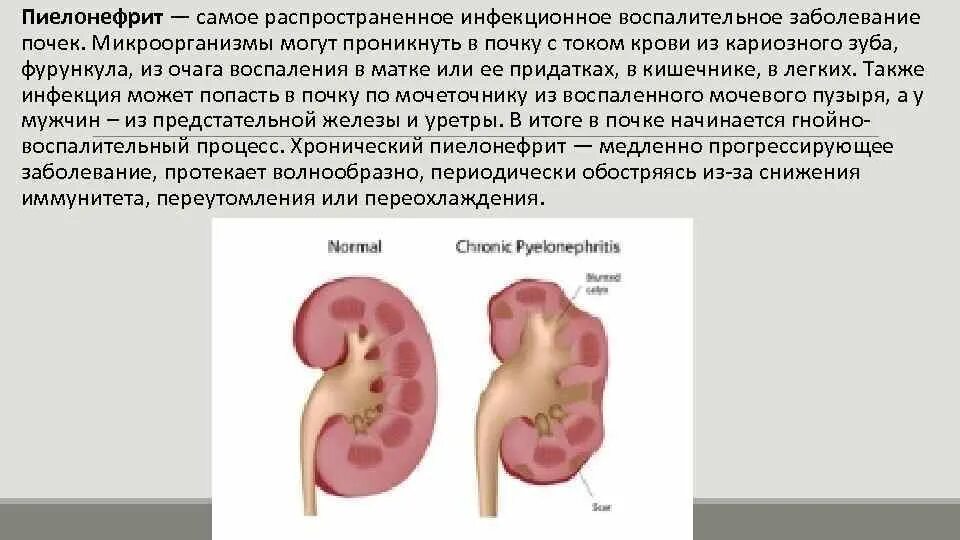 Болезнь почек пиелонефрит. Пиелонефрит и мочекаменная болезнь. Почечная болезнь пиелонефрит. Мочекаменная болезнь хронический пиелонефрит.