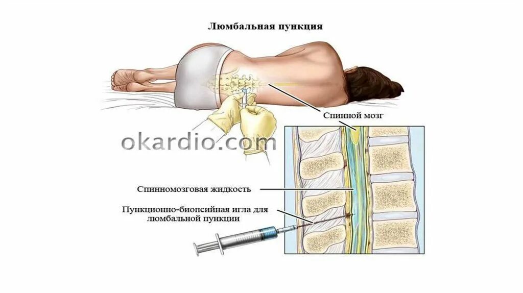 Сколько делают пункцию. Техника проведения пункции костного мозга. Инструменты для люмбальной пункции. Люмбальная пункция техника а 4 книж. Набор инструментов для люмбальной пункции.