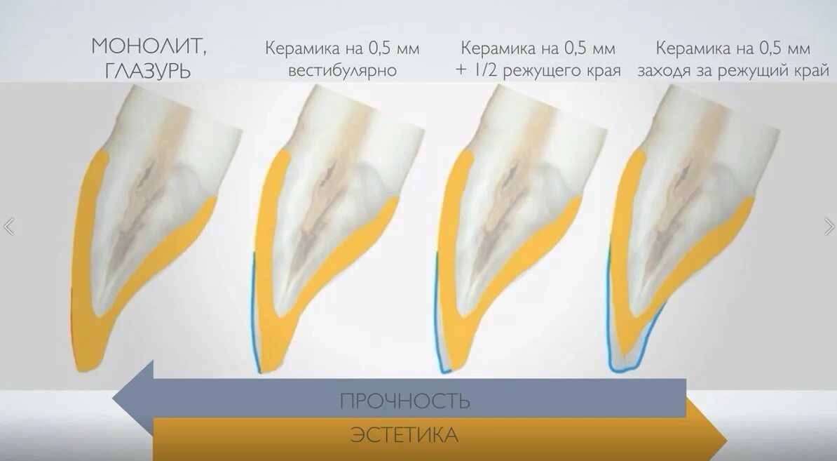 Препарированный зуб под коронку. Цельнокерамическая коронка препарирование. препарирование зубов под опорные коронки. препарирование зуба под виниры.