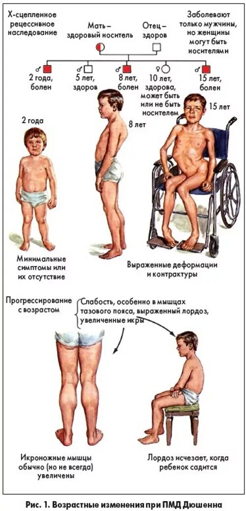 Заболевание миопатия. Симптомы прогрессирующей мышечной дистрофии. Синдром мышечной дистрофии Дюшенна. Синдром Дюшена миопатия Дюшенна.