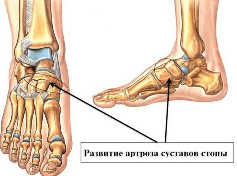 Почему болит голеностопный сустав. Деформирующий артроз таранно-ладьевидного сустава. Артроз таранно пяточной стопы. Остеоартрит голеностопного сустава. Деформирующий артроз голеностопа.