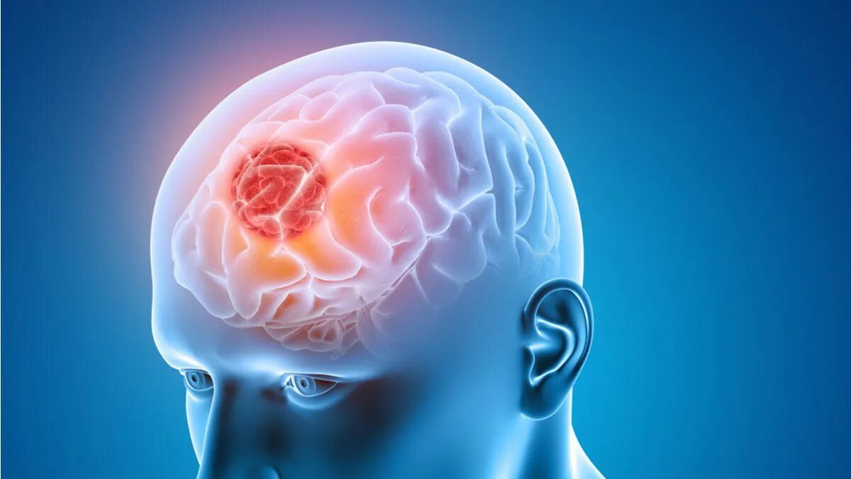 Головной мозг медицина. Всемирный день борьбы с опухолями головного мозга. Череп и мозг человека опухоль головного мозга над левым глазам.