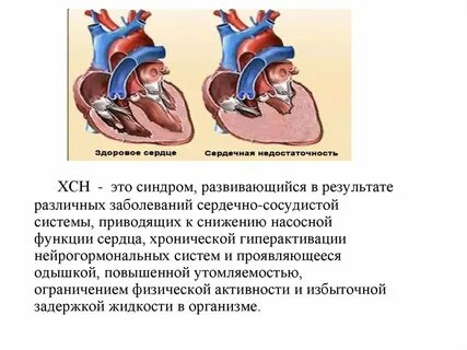 Сердечно легочная недостаточность