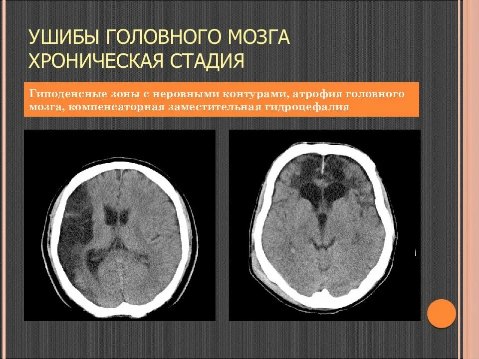 Гиподенсивный очаг кт головного мозга. Гиподенсный очаг печени кт. Гиподенсные очаги головного мозга. Гиподенсные очаги головного мозга. Кт субдуральной гематомы.