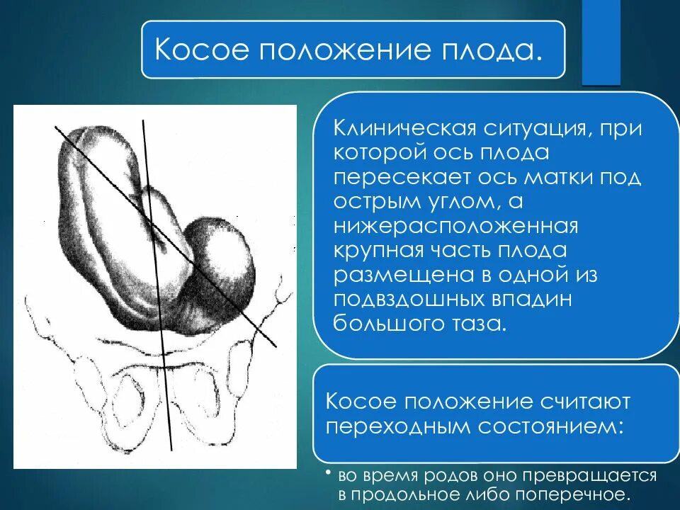 Положение эмбриона. Поперечные и косые положения плода. тактика при поперечном положении плода. поперечное положение плода.
