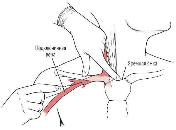 Правая подключичная вена. Проекционная линия подключичной вены. Проекция подключичной вены. Пункция и катетеризация подключичной вены. Проекция подключичной артерии.