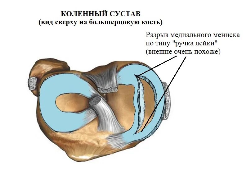 Медиальный мениск разрыв медиального. Повреждение внутреннего мениска коленного сустава ручки лейки. Повреждение внутреннего (медиального) мениска. Разрыв рога мениска коленного сустава.