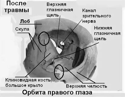 Верхняя глазничная щель на черепе