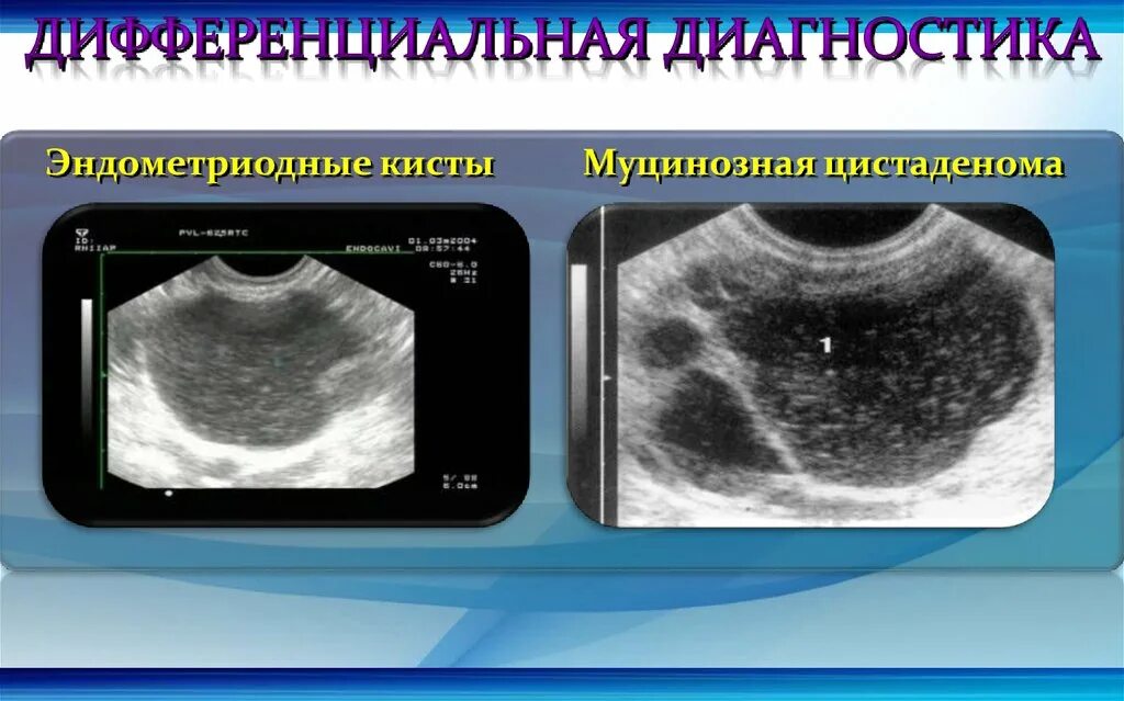 Муцинозные опухоли яичников. Псевдомуцинозная киста. Цистаденофиброма яичника на УЗИ. УЗИ дифференциальный диагноз кист яичников. Муцинозные кисты яичников на УЗИ.