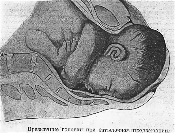 Распущенные волосы во время родов