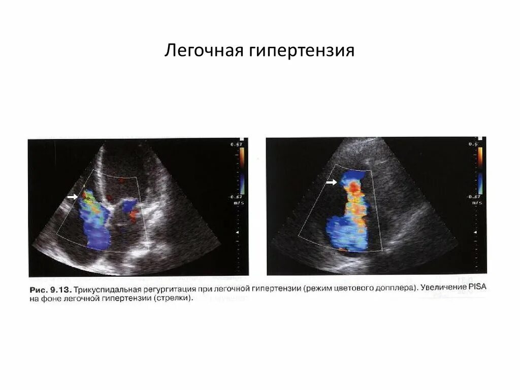 Легочная гипертензия по трикуспидальной регургитации. Митральная регургитация допплер. Персистирующая легочная гипертензия. Степени легочной гипертензии по УЗИ.