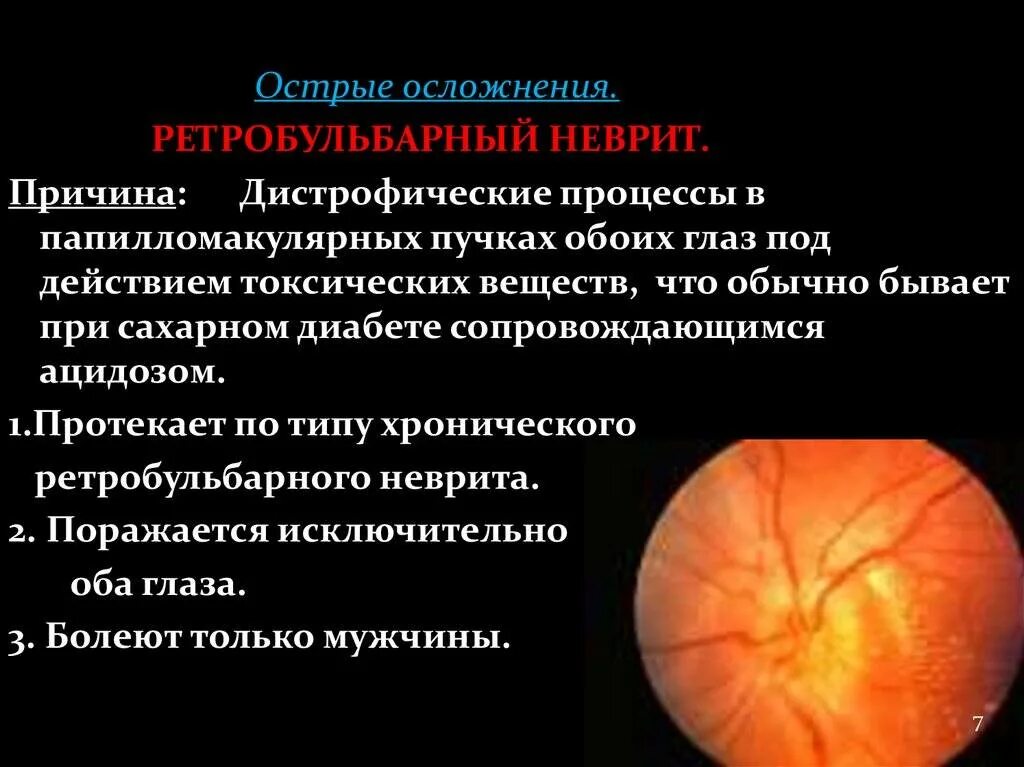 Патогенез ретробульбарного неврита зрительного нерва. Папиллит зрительного нерва. Зрительный неврит причины. Зрительный неврит причины. Папиллит (оптический неврит).