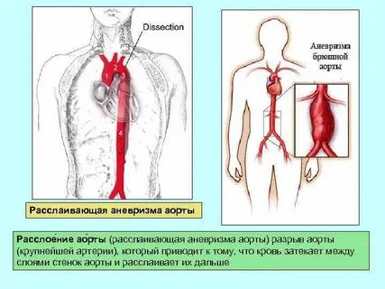 Аневризма аорты что это простыми словами