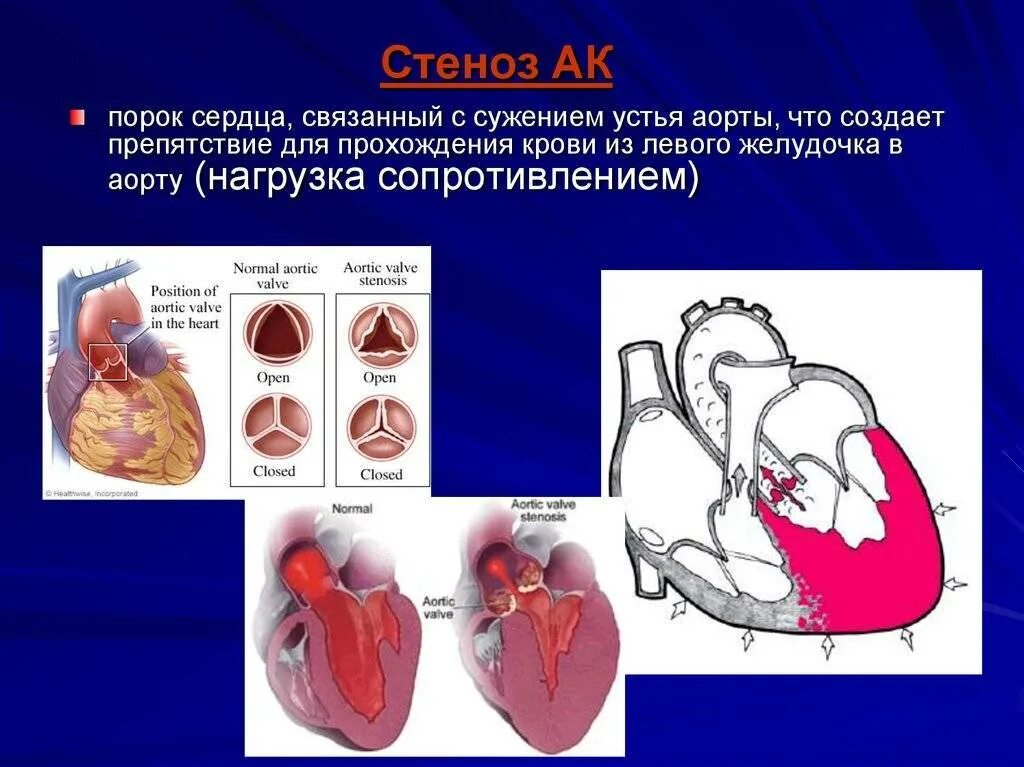 Аортальный стеноз что это такое. Аортальный стеноз патофизиология.