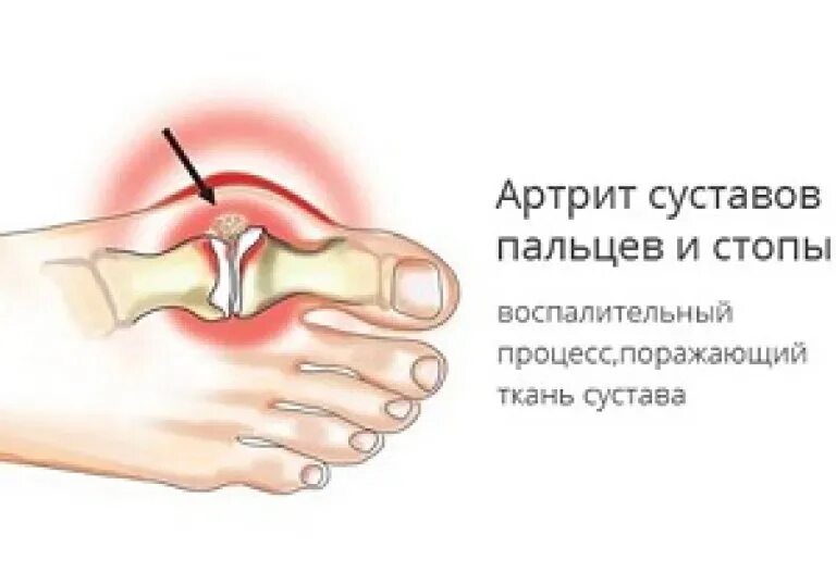 Почему болит сустав большого пальца на ноге. Почему болит сустав большого пальца на ноге