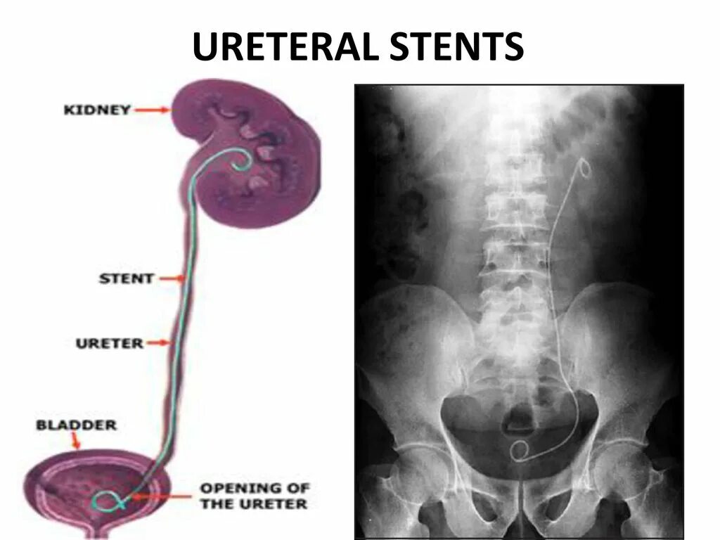 Ощущений мочеточник. Стенд в мочеточнике стент в мочеточнике. Стенд катетер для мочеточника. Устье мочеточника в мочевом пузыре. Стенд для расширения мочеточника.