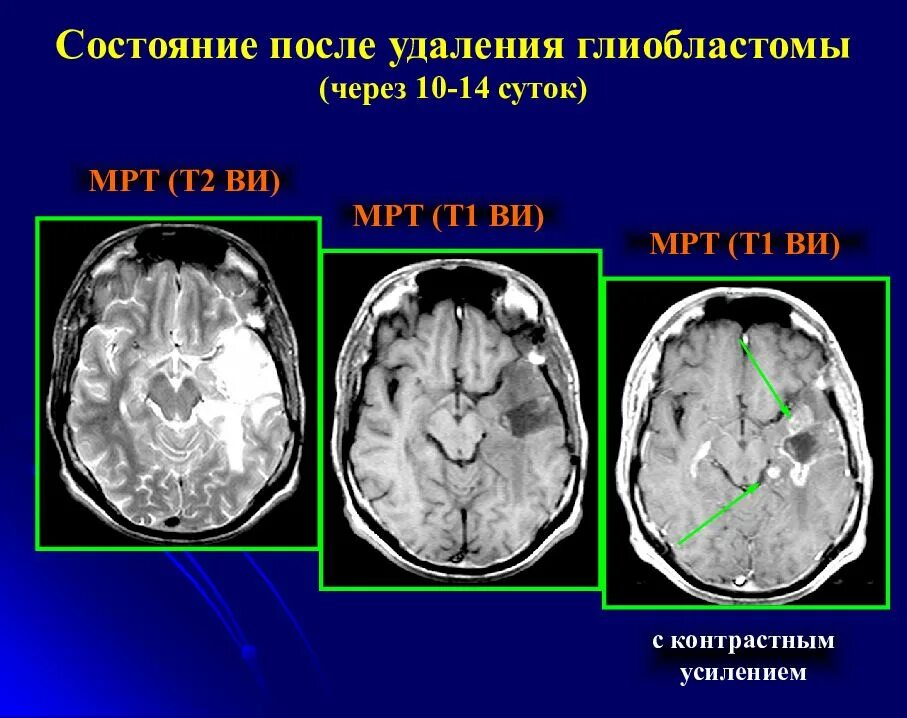 Глиобластомы головного мозга. Удаление глиобластомы