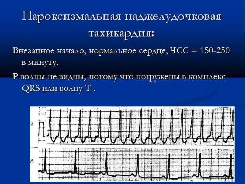 Сколько экстрасистол норма