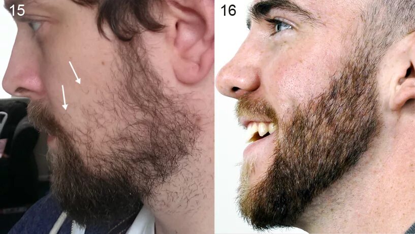 Почему появляется борода. Густая щетина. Редкая борода. Отращивание бороды. Виды бороды.