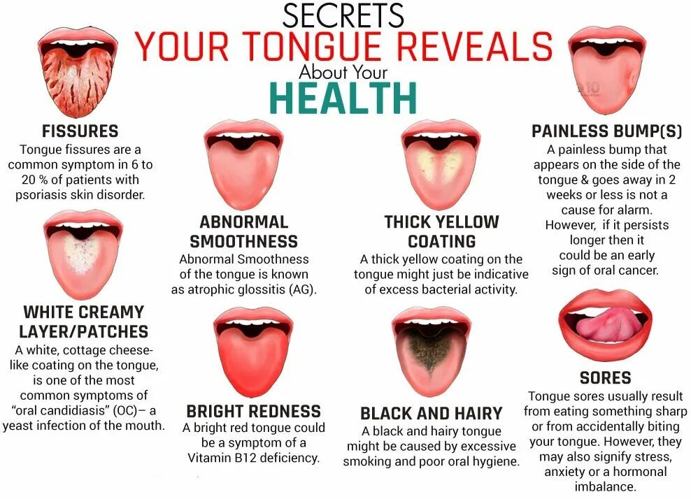 Заболевания по цвету языка. Цвет языка по заболеваниям. State tongue