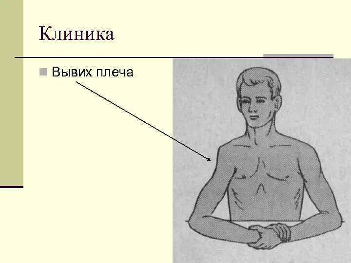 Вывих плеча помощь. Вывих плеча клиника диагностика. растяжение связок клиника.