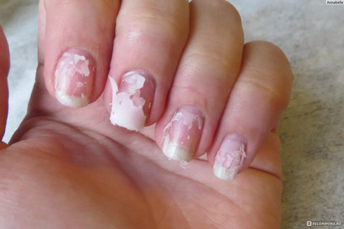 ногти после снятия гель лака. ногти после нарощенных ногтей. ногти после снятия наращивания. погрызанные ногти до и после. ногти после наращивание ногтей.