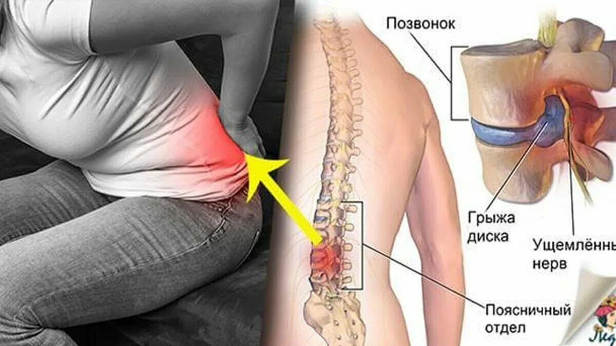 Боли в месте операции. Междисковая грыжа позвоночника. Грыжа пояснично-крестцового отдела позвоночника. Грыжа позвоночника поясничного отдела симптомы.