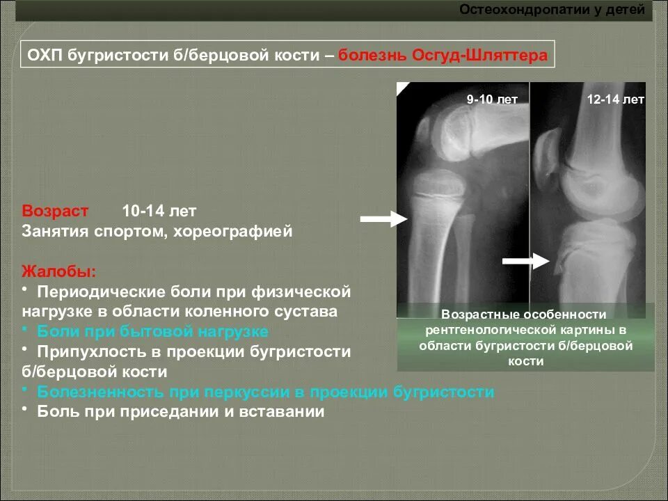 Шляттера мкб 10. Осгуда-Шлаттера коленного сустава. Рентген коленного сустава болезнь Осгуда Шлаттера. Асептический некроз коленного сустава рентген. Рентген картина болезни Осгуд Шляттера.