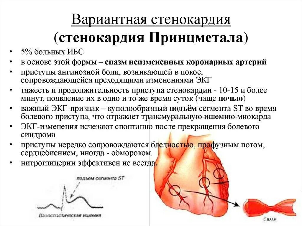 ЭКГ критерии стенокардии Принцметала. Вазоспастическая стенокардия Принцметала на ЭКГ. ЭКГ признаки вазоспастической стенокардии. Стенокардия Принцметала симптомы. Боли при ишемии