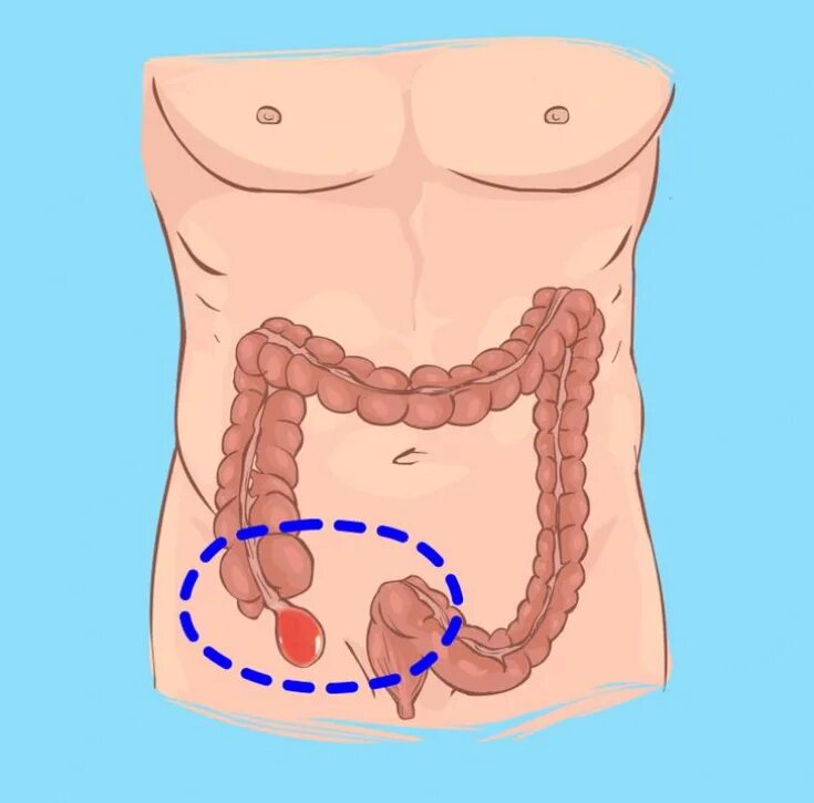 С какой стороны находится аппендикс у мужчин. Червеобразный отросток толстой кишки.