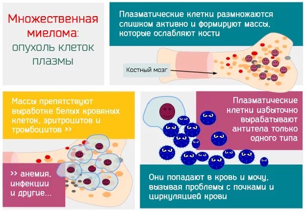 Миеломная болезнь плазматические клетки. Множественная миелома этиология патогенез. Множественная миелома патогенез кратко. Миеломная болезнь этиология. Опухоль клеток крови