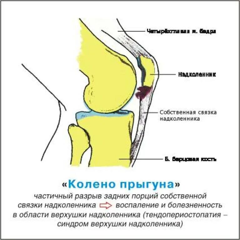 Тендинит коленных связок. Колено прыгуна тендинит надколенника. Повреждение связки надколенника симптомы. Тендинопатии собственной связки надколенника. Колено прыгуна Собственная связка надколенника.