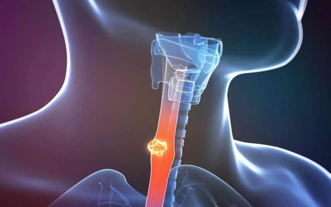 Гортань клиника. Злокачественные заболевания пищевода. Онкология гортани и пищевода.