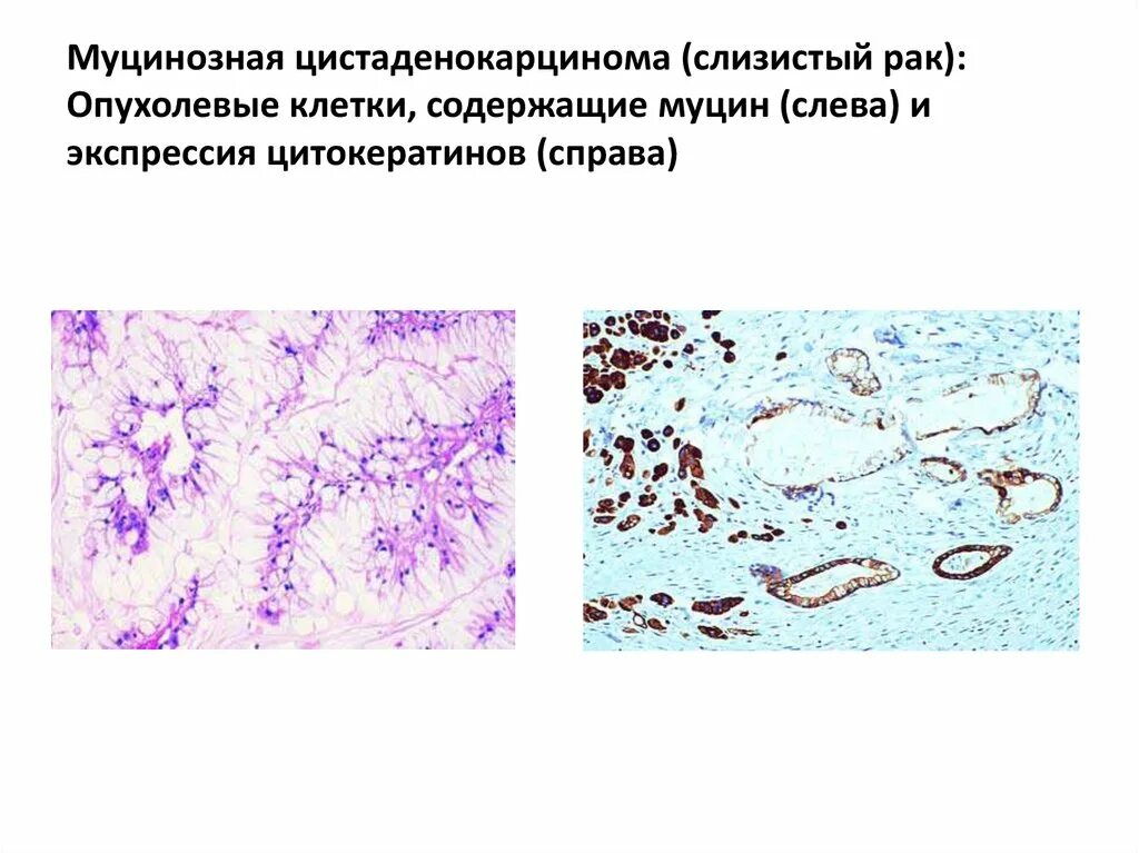 Муцинозные опухоли яичников. Муцинозная цистаденома гистология. Муцинозная аденокарцинома желудка гистология. Муцинозная аденокарцинома яичника гистология. Цистаденокарцинома молочной железы гистология.