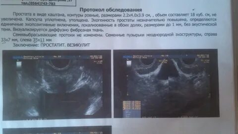 Предстательная железа эхогенность повышена