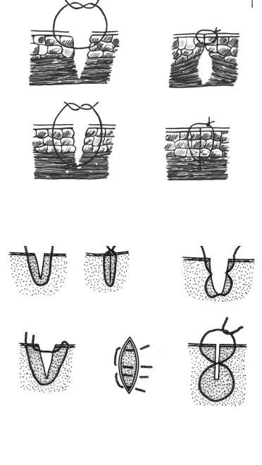 Техника наложения хирургических швов