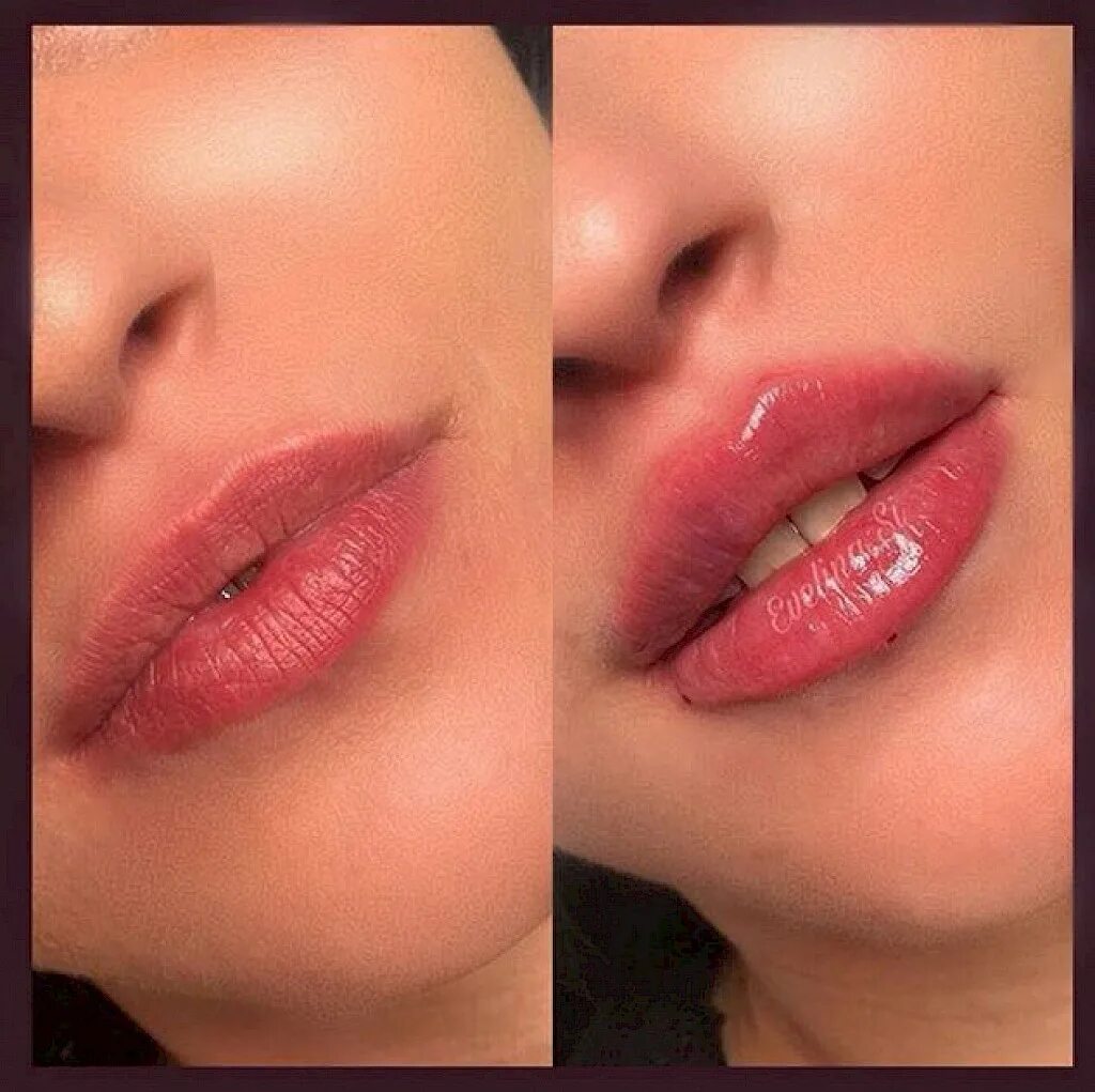 Ювидерм смайл для губ 1 мл. Мужские губы увеличения гиалуронка. Увеличение губ гиалуроновой кислотой. Увеличение губ гиалуроновой кислотой. Накачивание губ гиалуроновой кислотой 1 мл.