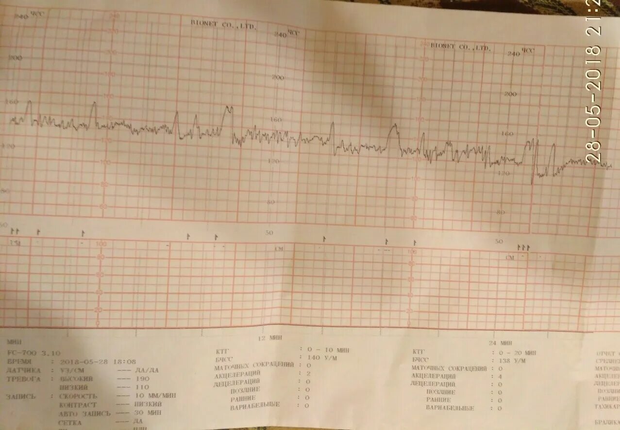 Схватки на 35 неделе. Нормальные показатели КТГ плода. Нормы по КТГ В 35 недель беременности. КТГ 35 недели беременности норма беременности. ЧСС на КТГ норма.