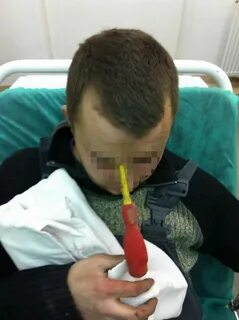 A 25-year-old Polish man underwent surgery for three hours recently after h...